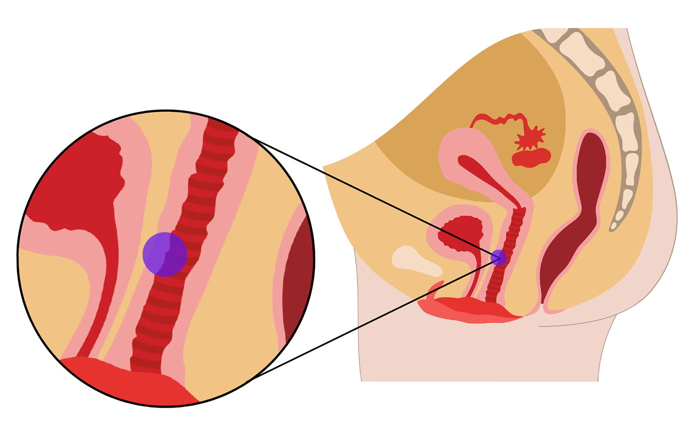 Wo ist der G-Punkt lokalisiert - Illustration Fraulila mit G-Punkt Bestimmung